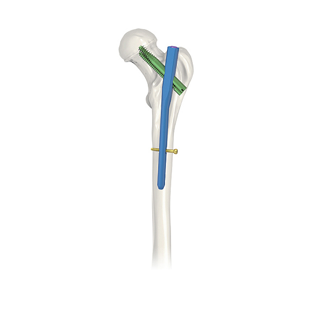 Nuevo diseño de diseño PFNA (gamma) Interlocking II (tipo estándar) con fémur con CE